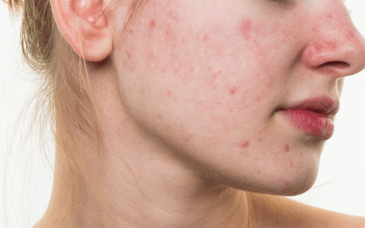 Trioderma Intensive Acne Spot Gel và bài toán chấm mụn không làm khô da