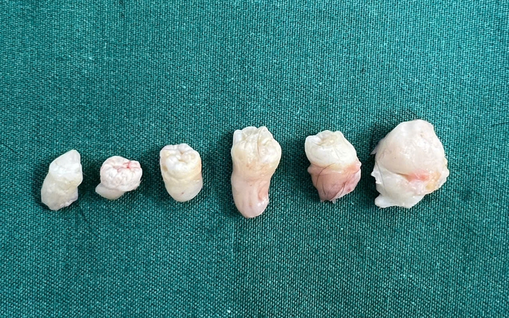 Hy hữu: Khối u trong bụng nữ bệnh nhân chứa 6 chiếc răng