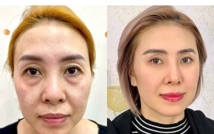 Xóa tan quầng thâm mắt bằng công nghệ Hydro Ultra Lift