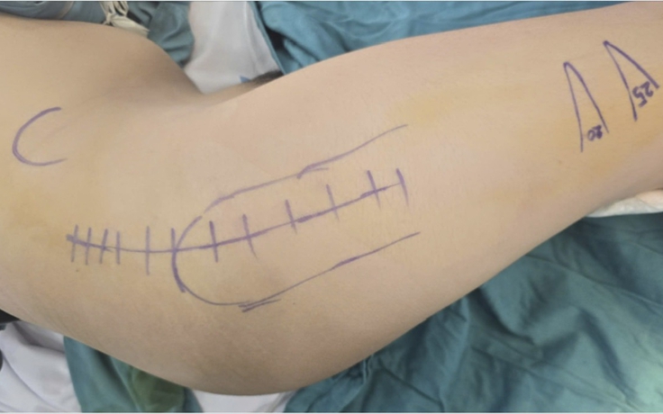 Bé 14 tuổi mắc bệnh lý chất trắng ở não, thoát cảnh ‘năm nào cũng phải mổ’
