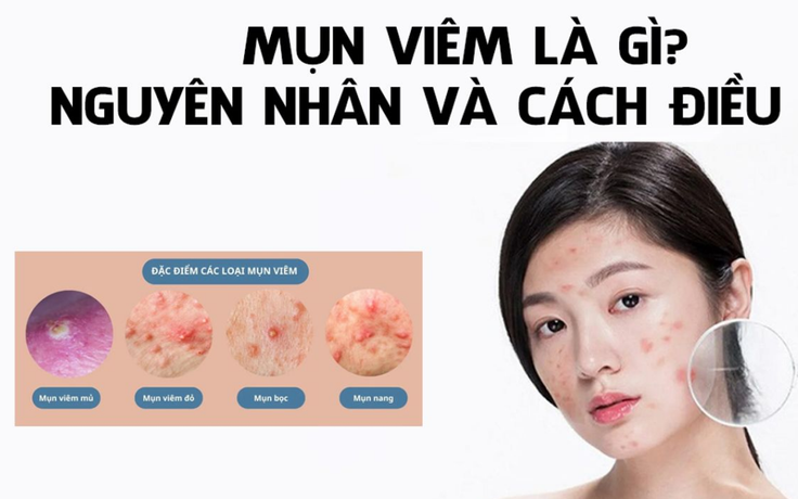 Bị mụn viêm sưng nên nặn không? Cần làm gì hết mụn mà không để lại sẹo?