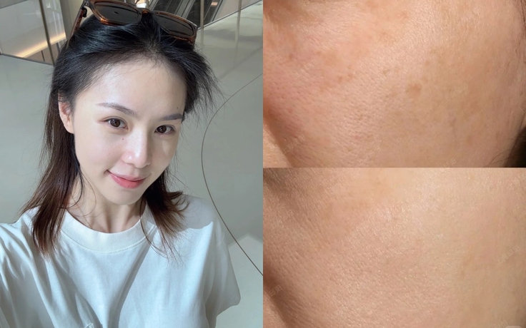 Top 6 serum mờ nám, tàn nhang sau khoảng 4 tuần khiến chị em đều không tin