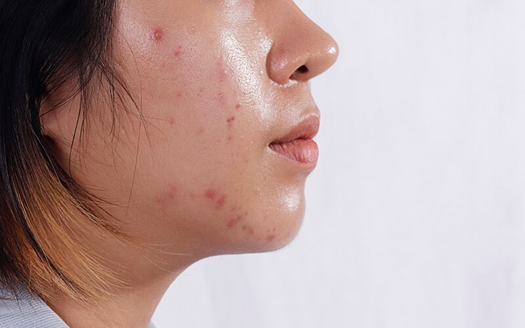 Vì sao mụn không dứt dù skincare đều đặn? Giải pháp cùng dược mỹ phẩm Việt Trioderma