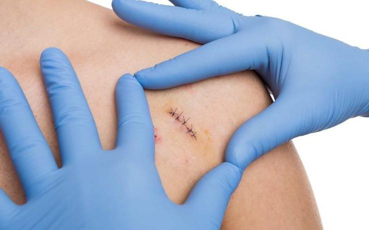 Plasma Cold: Hướng đi mới giúp rút ngắn thời gian lành thương sau phẫu thuật