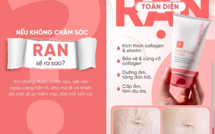 Kem xóa mờ rạn da nào hiệu quả với rạn da trắng - Chuyên gia nói gì?