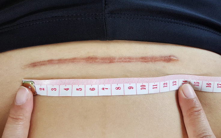 Đứng trước gương 6 tuần sau sinh, mẹ có nên quan tâm vết sẹo mổ sau sinh?