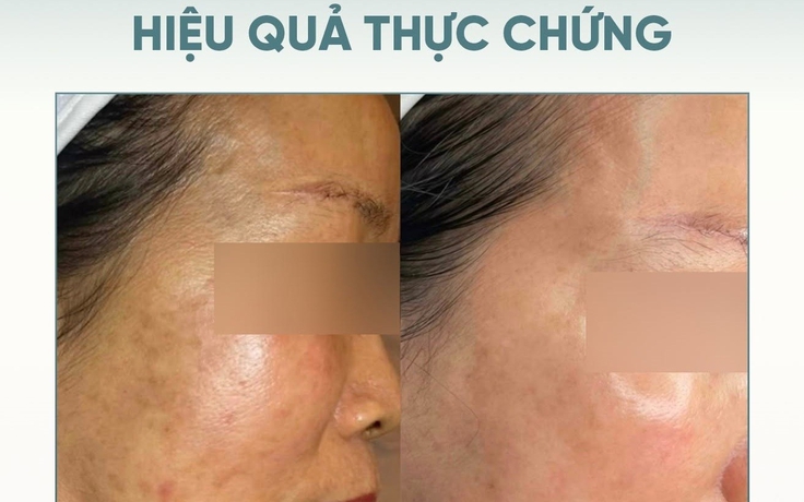 Top 5 kem mờ nám hiệu quả với cả hỗn hợp lâu năm, hết hàng liên tục