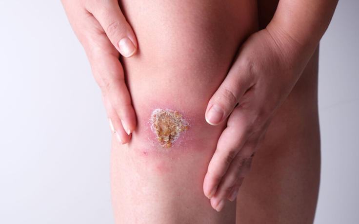 Vết thương hở lâu lành: Giải mã nguyên nhân và cách xử lý chuẩn y khoa