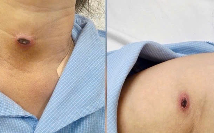 Nhận diện bệnh sốt mò
