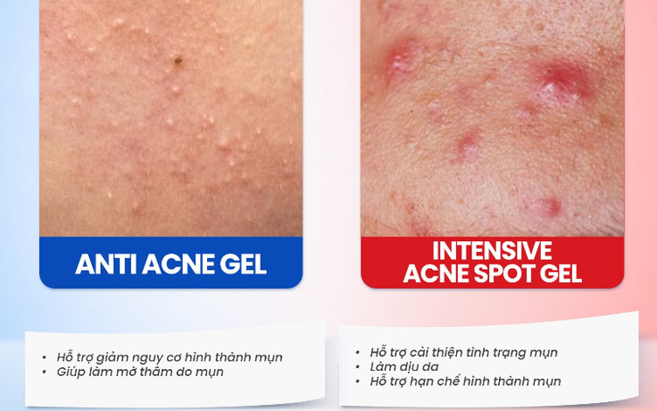 Gel chấm mụn Trioderma hiệu quả với loại mụn nào mà giới skincare đua nhau tìm mua?