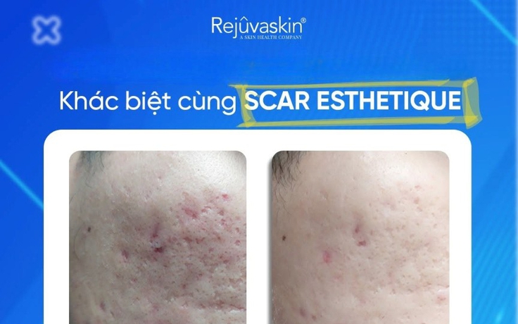 Kem mờ sẹo rỗ nào hiệu quả với cả sẹo lâu năm mà không cần xâm lấn?