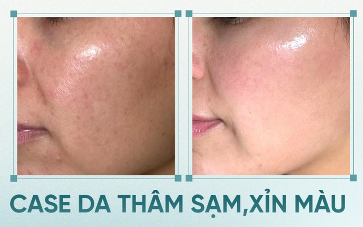 +5 serum mờ nám mảng, nám chân sâu; hiệu quả cả nám lâu năm không xâm lấn +5 serum mờ nám mảng, nám chân sâu; hiệu quả cả nám lâu năm không xâm lấn