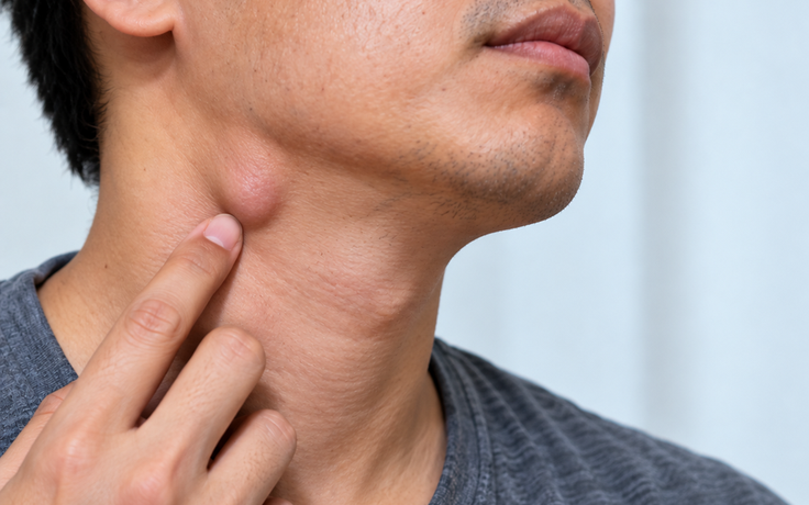 4 dấu hiệu cảnh báo hạch ở cổ là bất thường