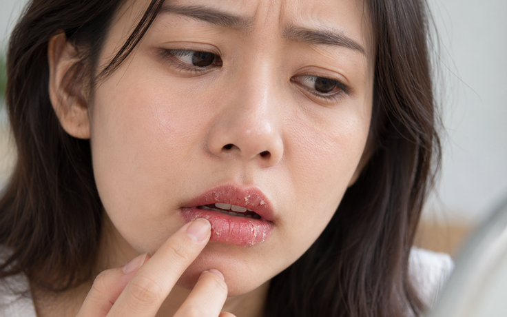 4 biểu hiện trên môi do cơ thể thiếu chất, mắc bệnh