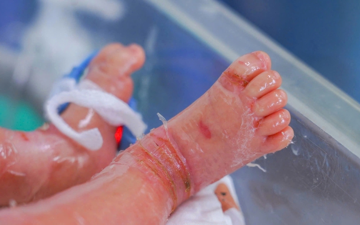Bé trai sinh non mắc bệnh vảy cá hiếm gặp, hồi phục sau 12 ngày điều trị