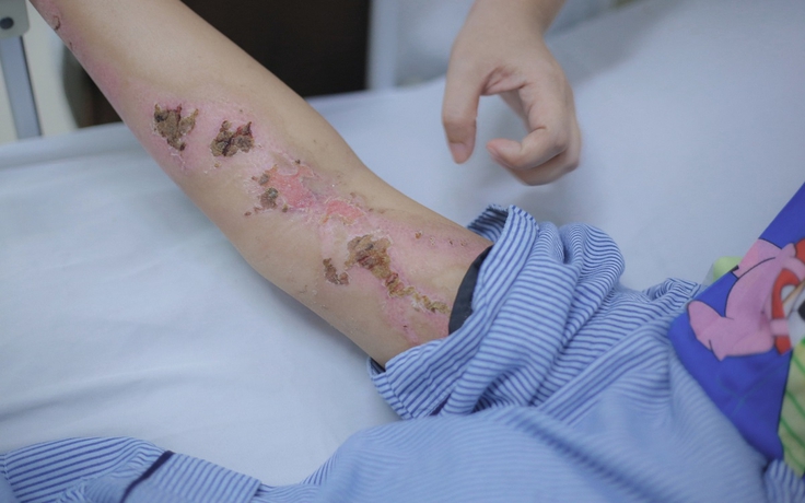 Bất ngờ bị sét đánh trên đường về nhà, người phụ nữ bỏng nặng