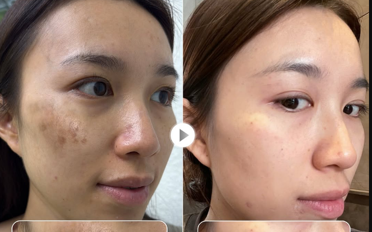 Top 3 kem giúp mờ nám chân đinh, đốm nâu lâu năm và không lo tái phát