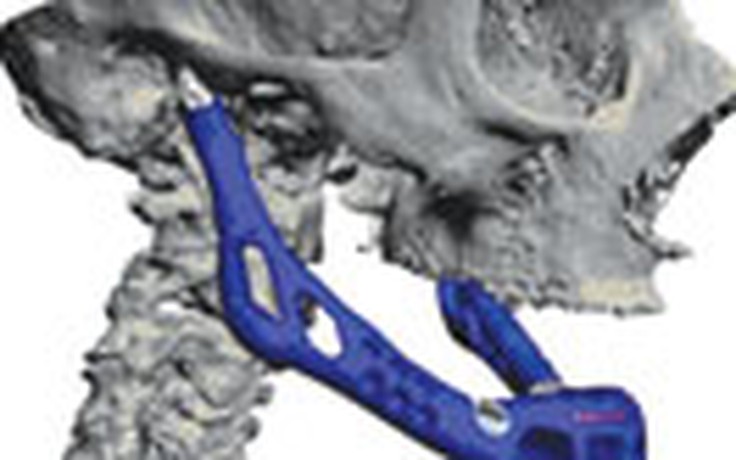 Máy in 3D tạo xương hàm dưới