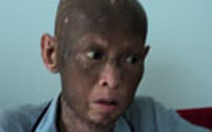 Bệnh lạ khiến một người sụt 40kg, lột da