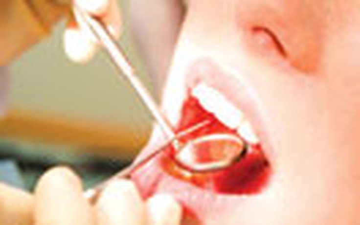 Cạo cao răng giúp ngừa đột quỵ
