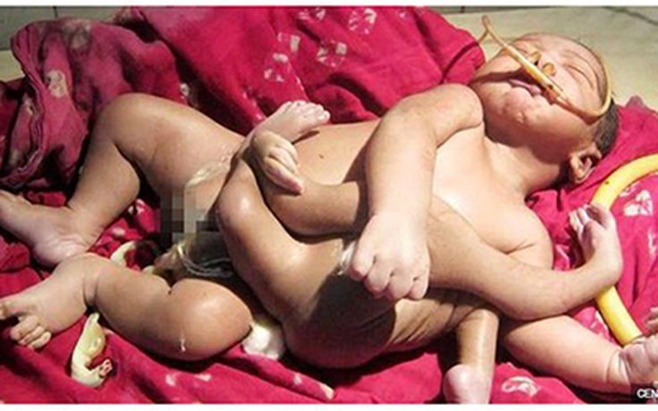 Em bé 4 tay, 4 chân ở Ấn Độ
