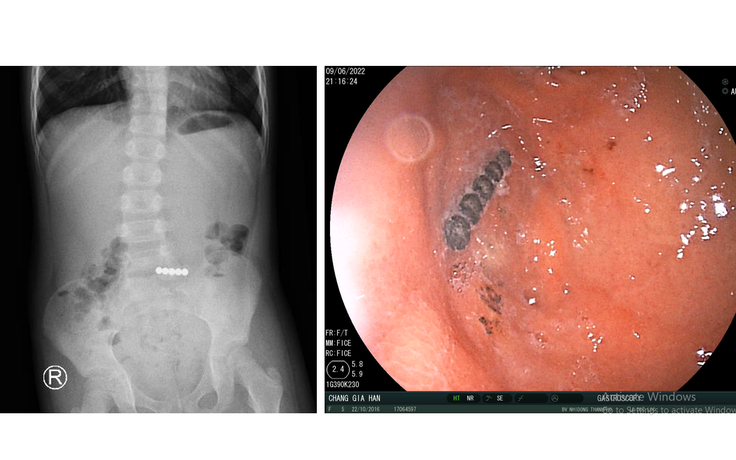 Giấu 5 viên bi nam châm trong miệng, bé 6 tuổi nuốt luôn vào bụng