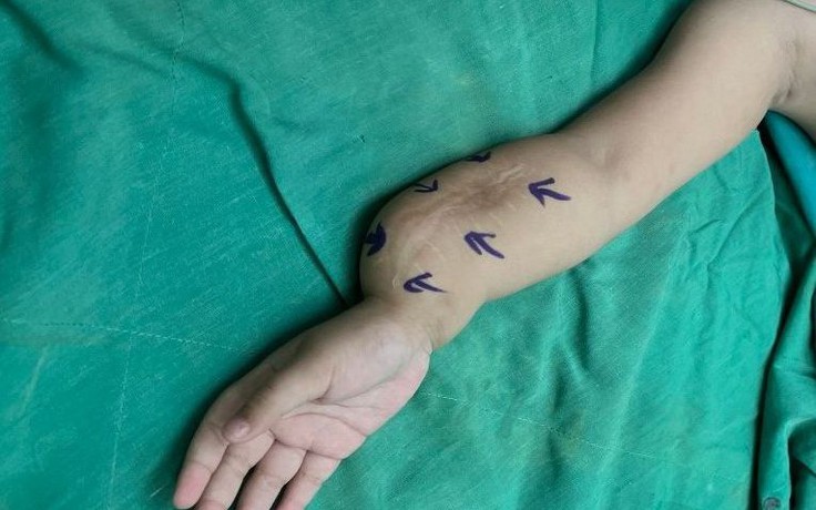 6 lần phẫu thuật chỉnh đôi tay bị khớp giả hiếm gặp trên thế giới