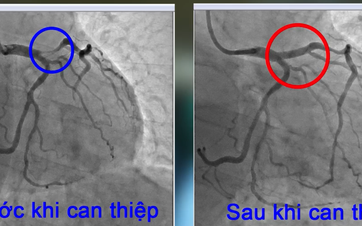 Cứu người đàn ông bị suy tim nặng sau nhồi máu cơ tim