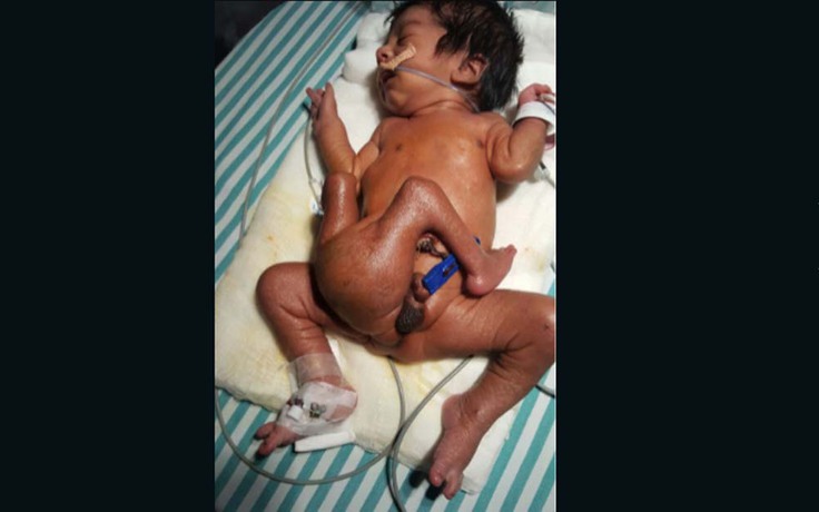 Phẫu thuật cứu sống bé trai có 4 chân, 2 cơ quan sinh dục