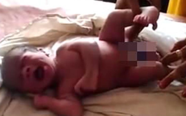 Em bé Ấn Độ có 4 chân và 2 cơ quan sinh dục