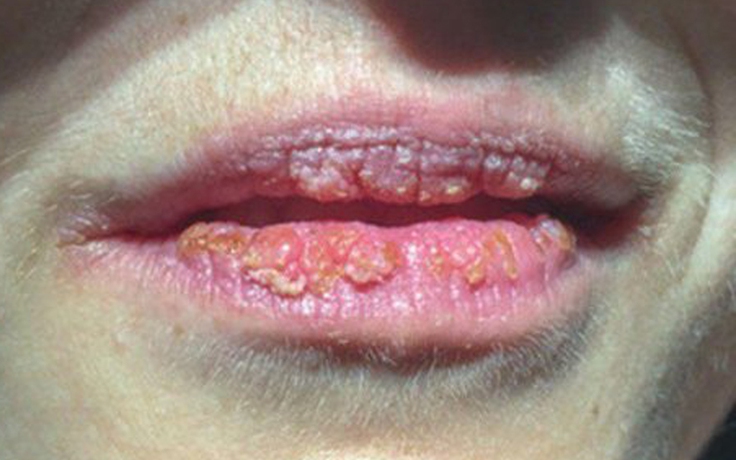 Vết loét sần trên môi là dấu hiệu cảnh báo bệnh ung thư gì?