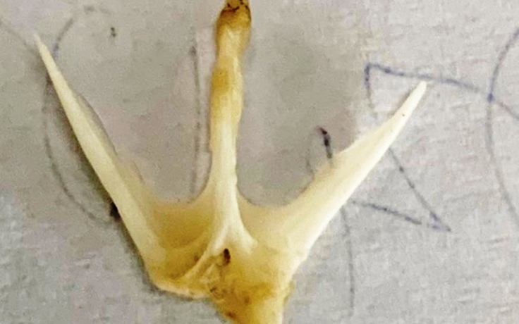 Quảng Nam: Gắp xương cá 4 chấu ra khỏi thực quản bệnh nhi 19 tháng tuổi