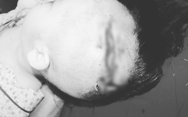 Bé 2 tuổi ở Hà Nội bị chó cắn rách đầu, nát mặt