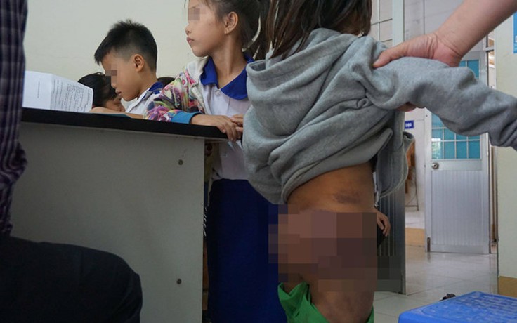 4 trẻ bị bạo hành ở Cà Mau: Chị họ đánh, thoa muối ớt lên vết thương