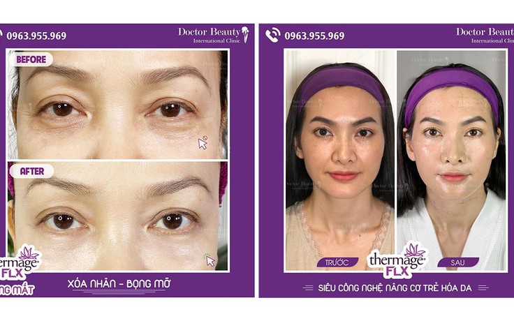 Doctor Beauty International Clinic tài trợ 50% Thermage FLX
