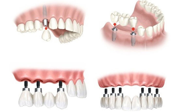 5 lý do giúp bạn quyết định có nên trồng răng Implant hay không