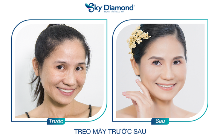 Treo mày đã thay đổi cuộc sống: Mắt sáng khỏe, trẻ trông thấy