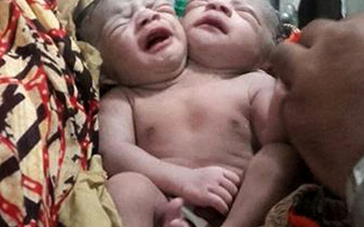 Bé gái sinh ra có hai đầu ở Bangladesh