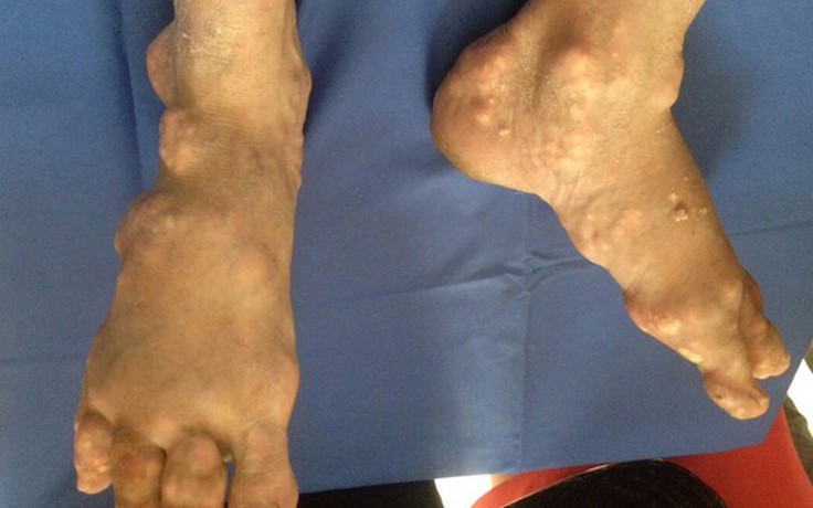 Tự trị bệnh gout 10 năm, người đàn ông bị biến dạng tay chân