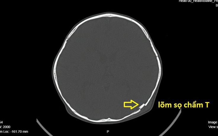 TP.HCM: Ngã xe đạp, bé trai 2 tuổi bị lõm sọ não