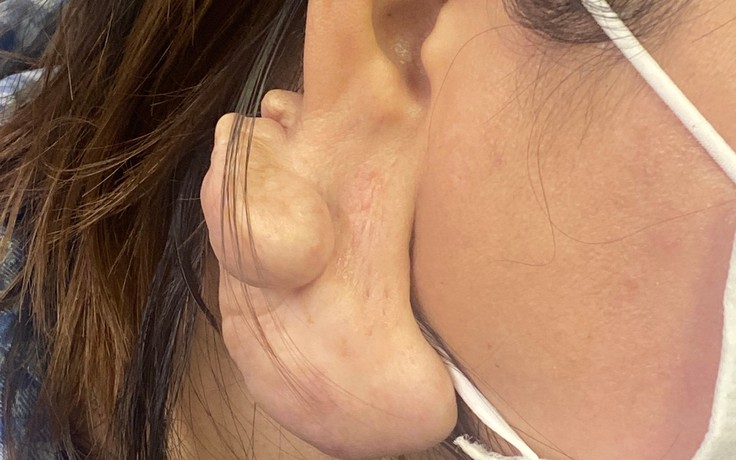 Dùng kim, chỉ xỏ lỗ tai, người phụ nữ bị u phì đại nặng đến 0,5 kg