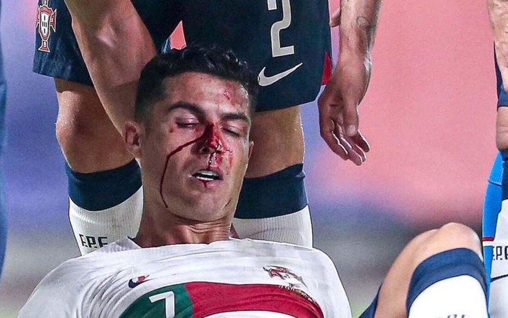 Cận cảnh pha bóng Cristiano Ronaldo đổ máu có khả năng bị gãy mũi