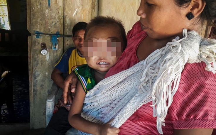 Những người mắc bệnh lạ: Cậu bé 2 tuổi không thể nhắm mắt