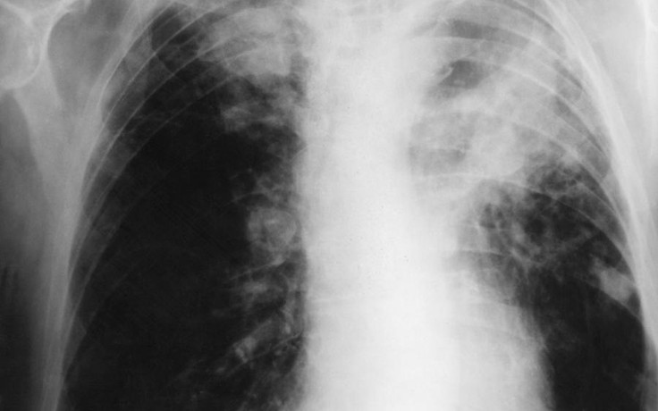 Những dấu hiệu lạ 'tố cáo' bạn có thể mắc ung thư phổi