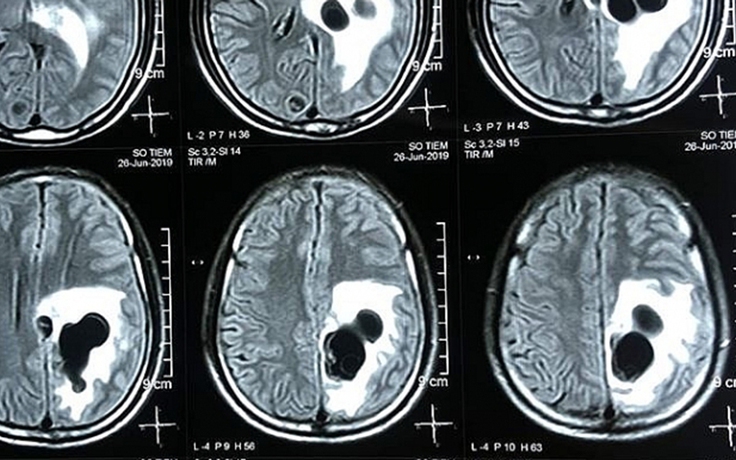 Cứu bệnh nhân nam có 5 ổ sán trong não
