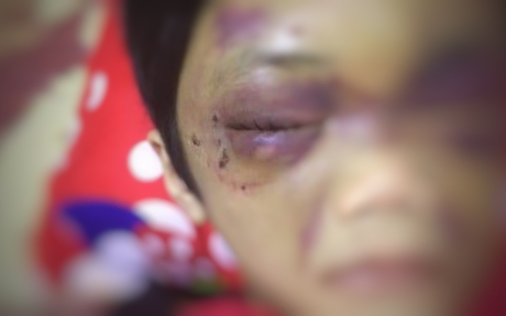 Bé gái 6 tuổi ở Hải Dương bị mẹ bạo hành thâm tím mặt