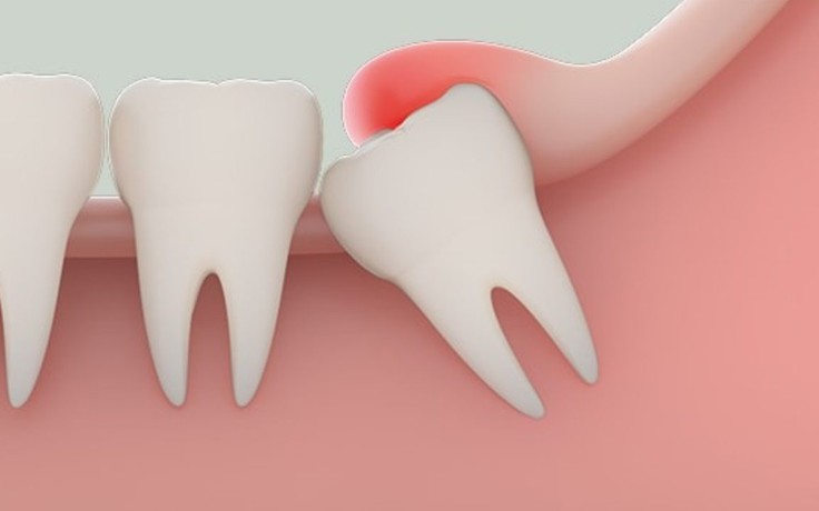 Làm gì để cầm máu, giảm đau sau nhổ răng khôn?