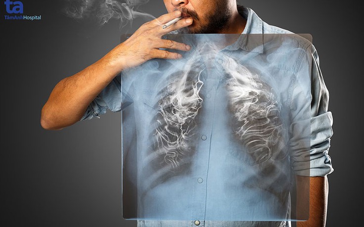 Gần 97% bệnh nhân ung thư phổi tại Việt Nam có hút thuốc lá