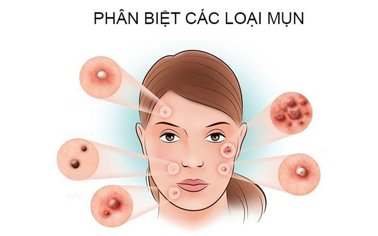 Phân biệt các loại mụn thường gặp và cách điều trị