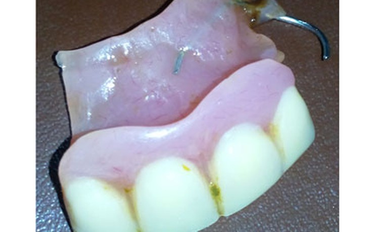 Phát hiện hàm răng giả trong... dạ dày